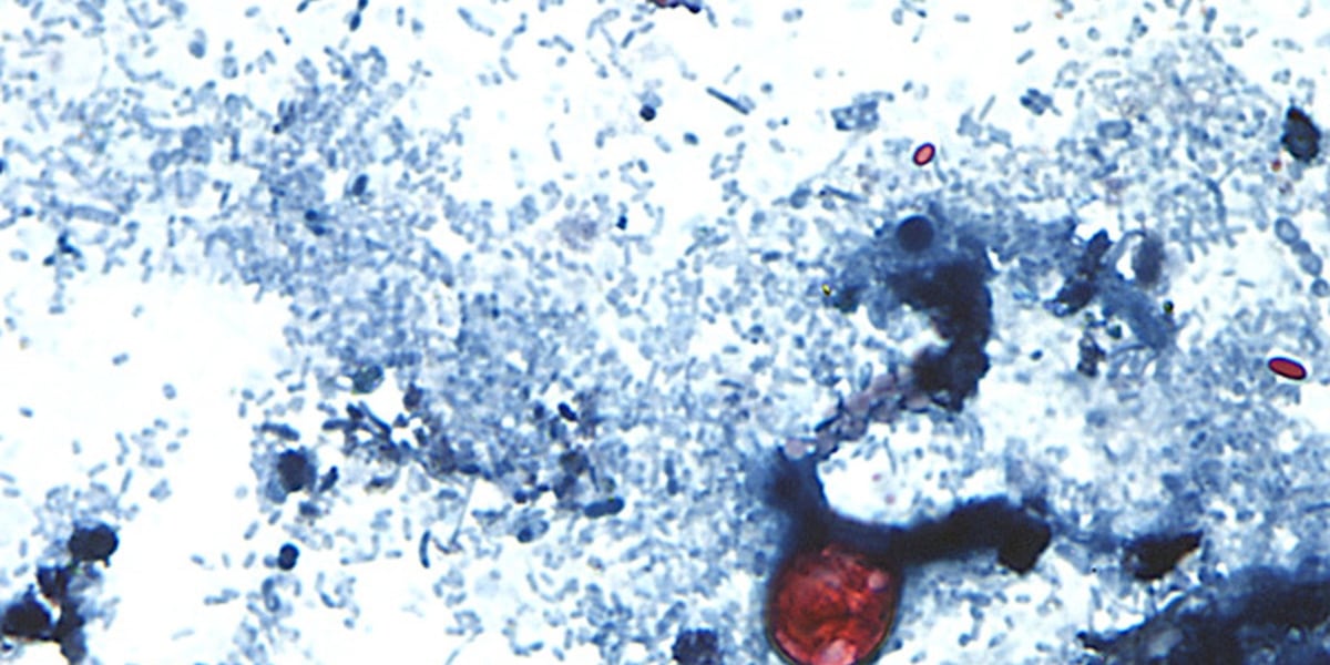 CDC Reports Rise in Georgia Parasite Cases